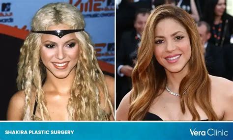 did shakira get plastic surgery